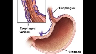 Esophageal Varices [upl. by Leahplar]