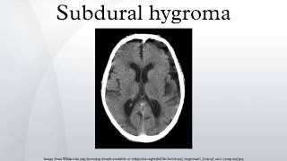 Subdural hygroma [upl. by Asik]