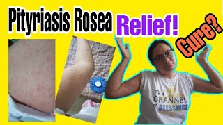 What is Pityriasis Rosea  My skin Condition [upl. by Angelina]