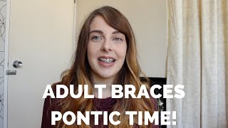 Adult Braces  I got Pontics [upl. by Gad448]