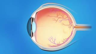 Trabecular Bypass Stent for Glaucoma [upl. by Asirralc23]