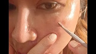 peeling my dark spots skin skincare skincareroutine skincaretips peeling skinpeel retinol [upl. by Yelnats]