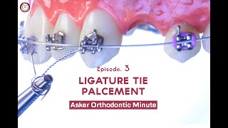 LIGATURE TIE Asker Orthodontic Minute Episode 3 [upl. by Kort]