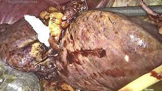 Central hepatectomy HCC [upl. by Lyreb]