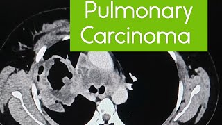 Lung cancer  Pulmonary Carcinoma  one of the common cancers pulmonary cancer ctscan [upl. by Yehus685]