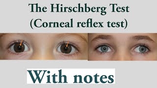 Hirschberg test Hirschberg corneal reflex testSquint lecture 10 [upl. by Vyner576]