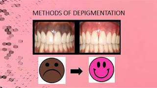 Gingival Melanin Depigmentation  Case Report [upl. by Robby]