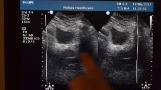 incompetent Cervix Sonography [upl. by Neslund468]