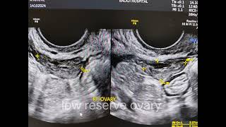 ovary with decreased follicles look in scanfertilityspecialist Dr swathi [upl. by Ilat]