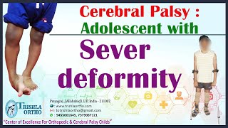 Cerebral Palsy  Adolescent with sever deformity [upl. by Geiss]