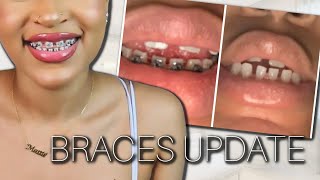 BRACES UPDATE  MY TEETH ARE SHIFTING  MISSING LATERAL INCISORS [upl. by Aivad]