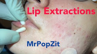 Lip extractions Whiteheads blackheads acne extractions on face Inflammatory pustules [upl. by Fabi]