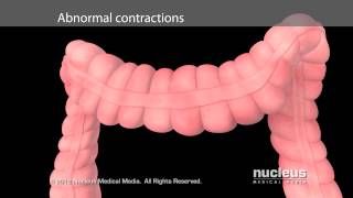 Irritable Bowel Syndrome IBS [upl. by Sheridan]