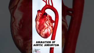 Aortic Aneurysm Animation Understanding the Condition short animation3d shorts [upl. by Monro691]