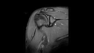 How does a post arthrogram MRI shoulder compare to a non contrast MRI for labral tear [upl. by Htebazileharas]