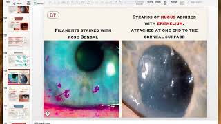 Non infective keratitis [upl. by Akiner423]