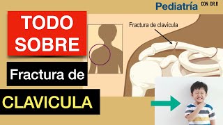 Fractura de clavicula en niños detectala traumatology [upl. by Lunna]