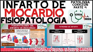 INFARTO AGUDO AL MIOCARDIO FISIOPATOLOGÍA  GuiaMed [upl. by Ekaj]