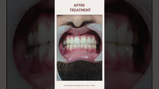 Front Broken Teeth Treatment shorts smile shortsfeed trending [upl. by Name]