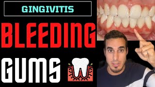 GINGIVITIS treatment and symptoms  INFLAMED GUMS and GUM DISEASE [upl. by Vladimir]