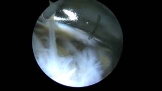 Epicondylite Tennis elbow  Arthroscopic treatment  Dr Falcone Clinique Jouvenet [upl. by Drofhsa]