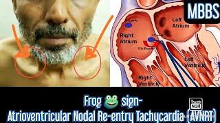 Frog Sign Cannon A wave AVNRT Atrioventricular Nodal Reentry Tachycardia mbbs usmle neet [upl. by Ambrosia322]