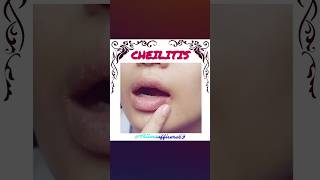 Cheilitis disease doctor nursing mbbs ytshorts education ssc song newsong [upl. by Izabel770]