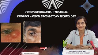 R DACRYOCYSTITIS WITH MUCOCELEENDO DCR  MEDIAL SACCULOTOMY TECHNOLOGY DRSHAKUNTALA GHOSH [upl. by Fisk]