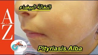 Pityriasis alba  From A to Z  النخالة البيضاء  اسبابها  أعراضها  طرق العلاج والوقاية [upl. by Caughey482]