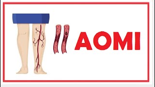 AOMI arteriopathie obliterante des membre inferieure [upl. by Arbua286]