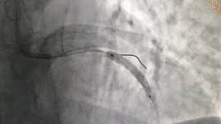 Angioplasty to critical Ostial Left Main Stem to Proximal Lad with 2 DES CABG refused by Patient [upl. by Milman436]