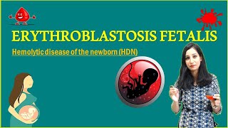 ERYTHROBLASTOSIS FETALIS II Hemolytic disease of the newborn HDN [upl. by Androw864]