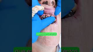 Descubre Como Los Implantes Dentales se Pueden Reutilizar implantesdentales saluddental shorts [upl. by Maynard601]