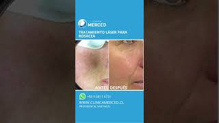 Tratamiento para rosacea [upl. by Eppesuig]