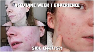 My Accutane Experience FIRST WEEK  Days 17 on Isotretinoin  Acne Update  Side effects [upl. by Enomsed]