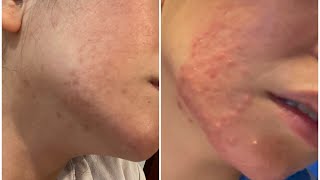 Lymecycline for Acne 3 Months Antibiotics  Weekly Vlogs [upl. by Arraeic741]