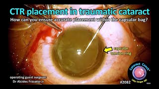 CataractCoach™ 2082 CTR placement in a traumatic cataract [upl. by Ail]