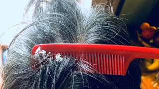 Dandruff build up  Scraping with comb [upl. by Dorrej792]