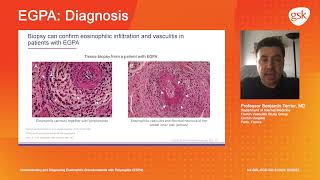 Diagnosis Understanding and diagnosing eosinophilic granulomatosis with polyangiitis EGPA [upl. by Aleron259]