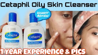 I Tried Cetaphil Oily Skin Cleanser For 1 Year😱Before amp After pics Best Cleanser for Oily Skin [upl. by Erle921]