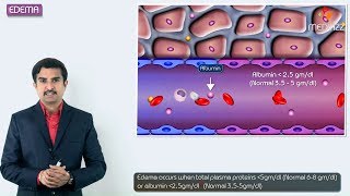 1Edema introduction  Hemodynamic pathology Fmge Neet PG and usmle [upl. by Irfan16]