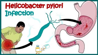 Helicobacter Pylori Infection Gastric Ulcer Causes Signs and Symptoms [upl. by Collayer284]