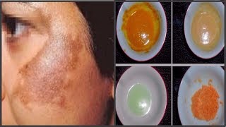 মেছতা দূর করতে ৪ ধরনের বিশেষ প্যাকHow to remove Melasma spot on your face [upl. by Aicercul882]