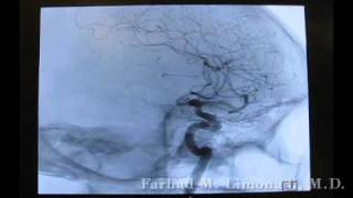 3D Cerebral Angiography [upl. by Ardnuassac235]