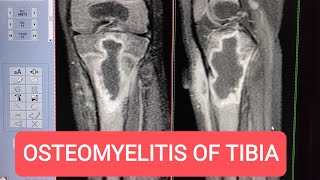 MRI of Tibia with Contrast  Diagnosing Osteomyelitis on GE 15 Tesla [upl. by Arfihs36]