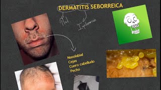 Dermatitis seboirreica Dermatología [upl. by Adanar]