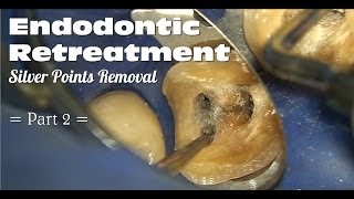 Endodontic Retreatment  Silver Points Removal Part 2 [upl. by Dinerman]