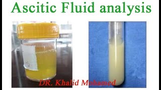 Ascitic fluid analysis تحليل السائل البريتوني [upl. by Fazeli]