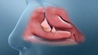 Nasal Polyp Removal Surgery [upl. by Heti]