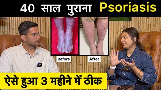 Psoriasis Treatment In Hindi Ft upasanakiduniya  Skin Disease  Himanshu Bhatt [upl. by Caryl]